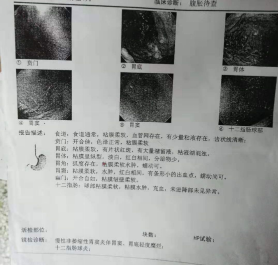 胃镜检查报告HP阳性含义解读：幽门螺旋杆菌感染深度分析及常见疑问解答