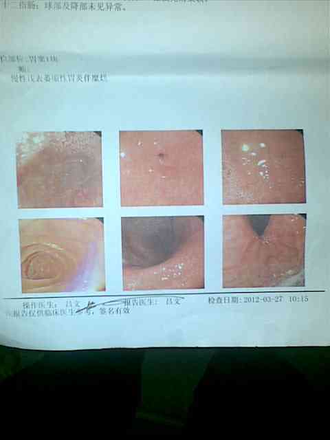 胃镜检查报告显示ai