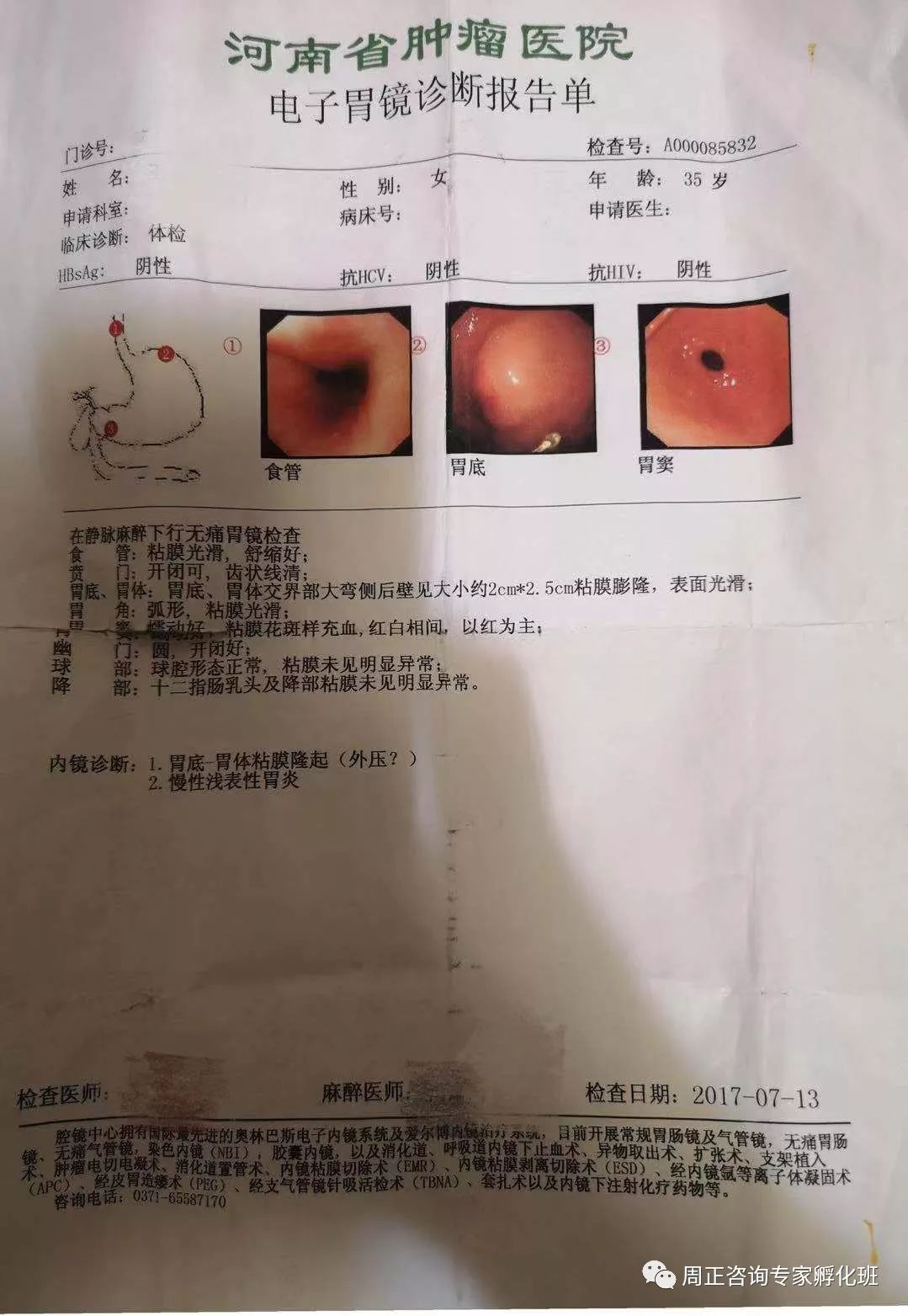胃镜检查报告显示ai
