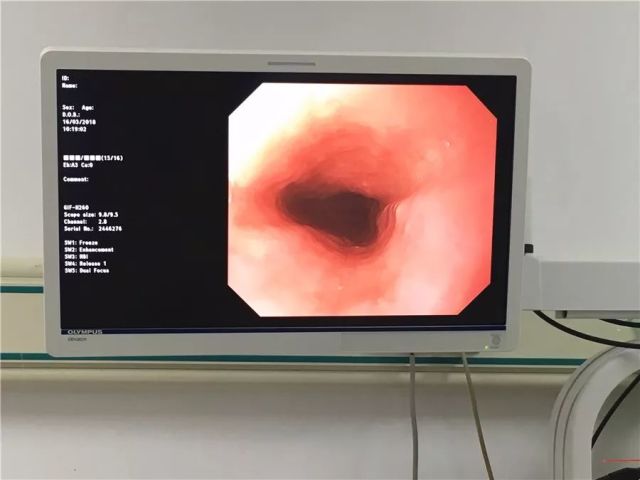 胃镜检查报告显示ai