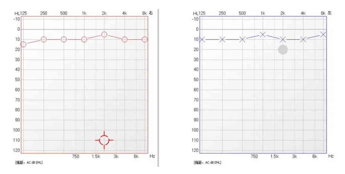 听力报告AI什么意思