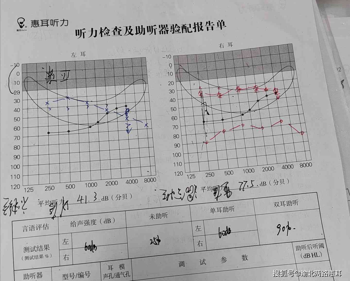 听力测试报告单ai是什么意思