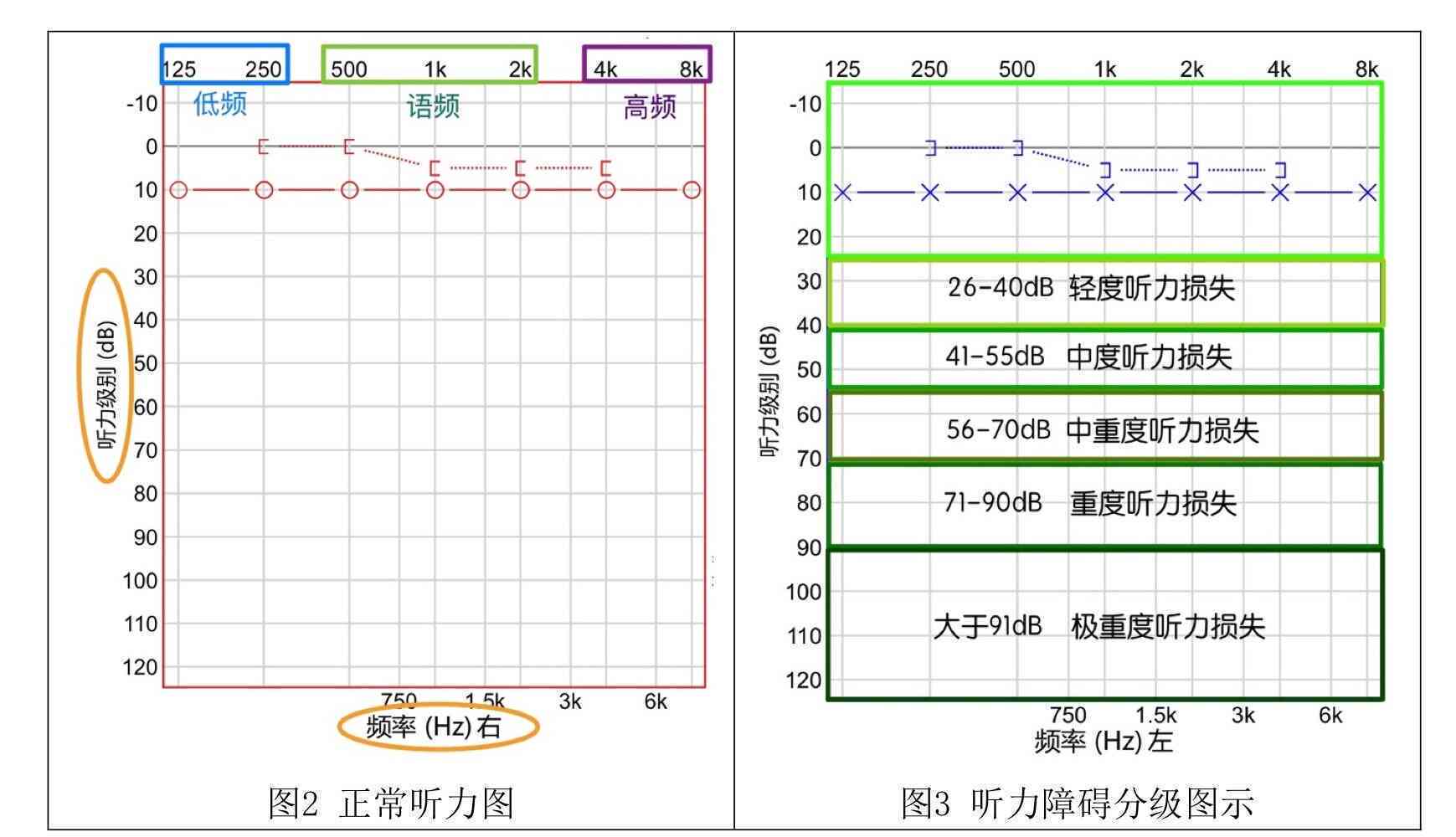 听力报告中ai是什么